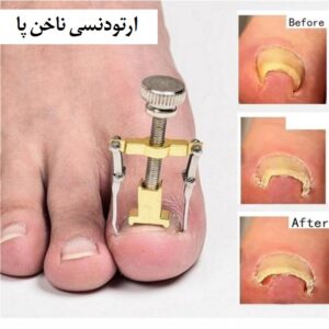 ارتودنسی-ناخن-پا